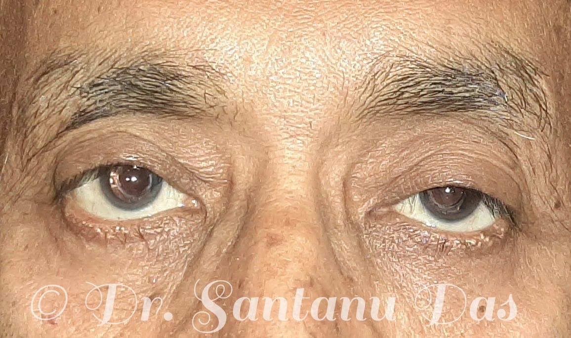 Ptosis Treatment Evaluation